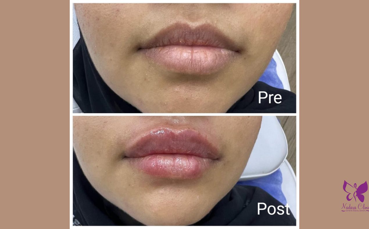 Best Dermal filler doctors in Hurghada